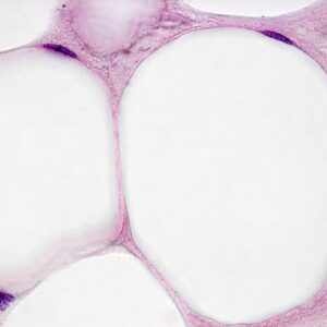 cristallisation des adipocytes